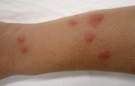 close-up look to bed bug bites on an arm close up bed bug bites on the arm